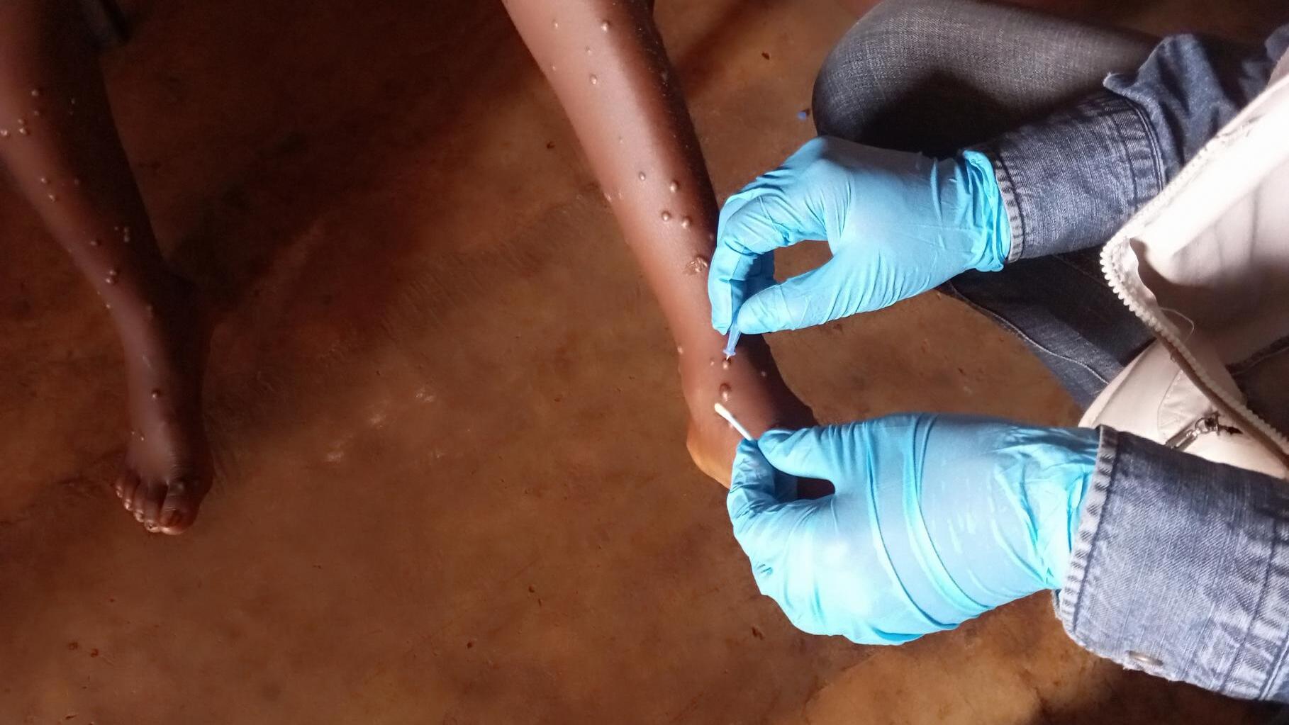 Un cas de Mpox détecté dans une prison ougandaise : une nouvelle alerte sanitaire